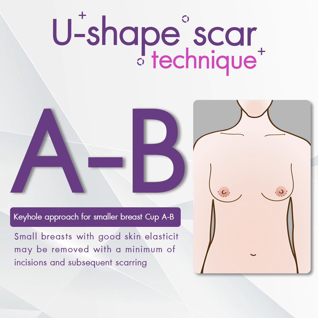 U-shape_case_review