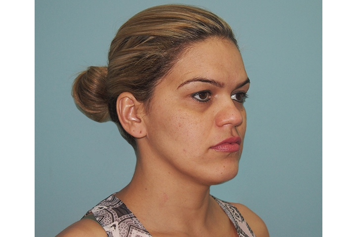 Facial contouring