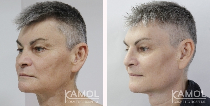 Before & After Masculin Nose