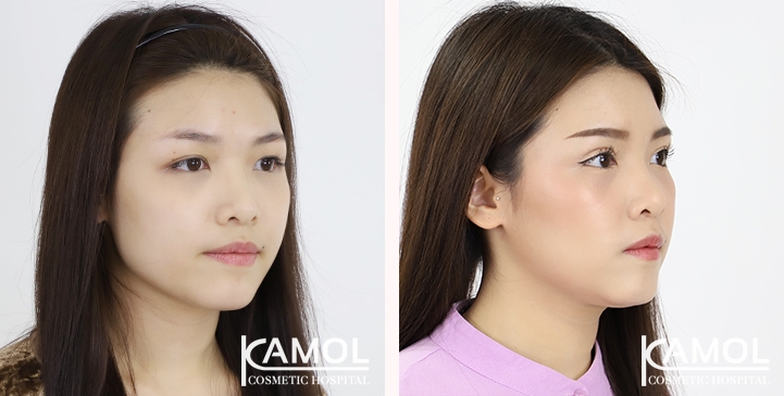 ภาพก่อนและหลัง ผ่าตัดทำตาสองชั้น/ ศัลยกรรมตา/ กล้ามเนื้อตาอ่อนแรง