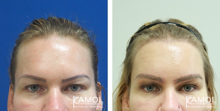 รูปก่อนและหลังการผ่าตัดดึงไรผม/ ดึงหน้าผาก/ แก้หน้าผากกว้าง (Hairline lowering, Scalp Advancement)