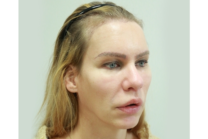 รีวิวการผ่าตัดดึงไรผม/ ดึงหน้าผาก/ แก้หน้าผากกว้าง (Hairline lowering, Scalp Advancement)