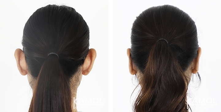 รูปก่อน-หลังศัลยกรรมหูกาง / แก้หูกาง