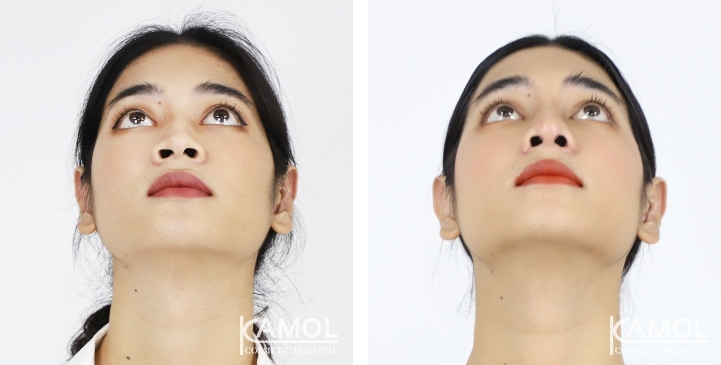 Rhinoplastie de révision avant et après 