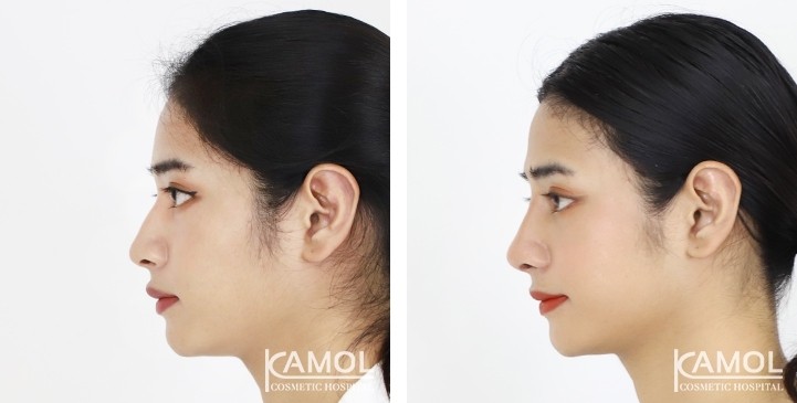 Rhinoplastie de révision avant et après 