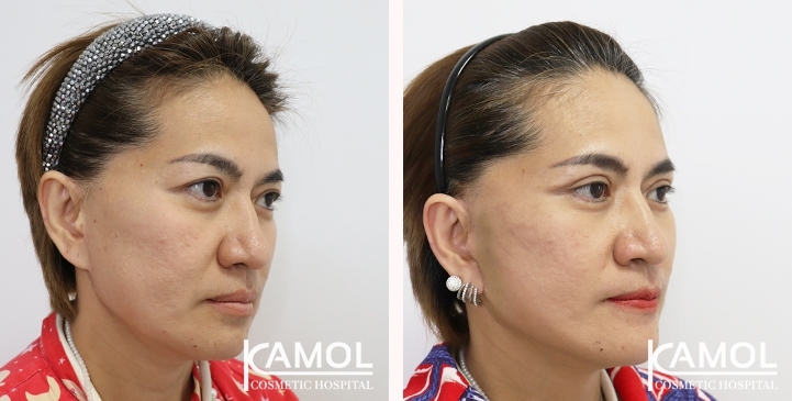 Before & After Facelift / Neck Lift