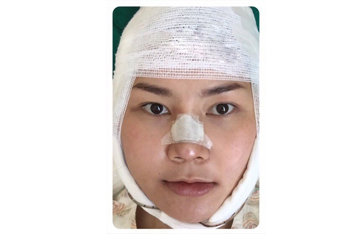 Reviews Jaw Reduction Surgery, Jaw shaving