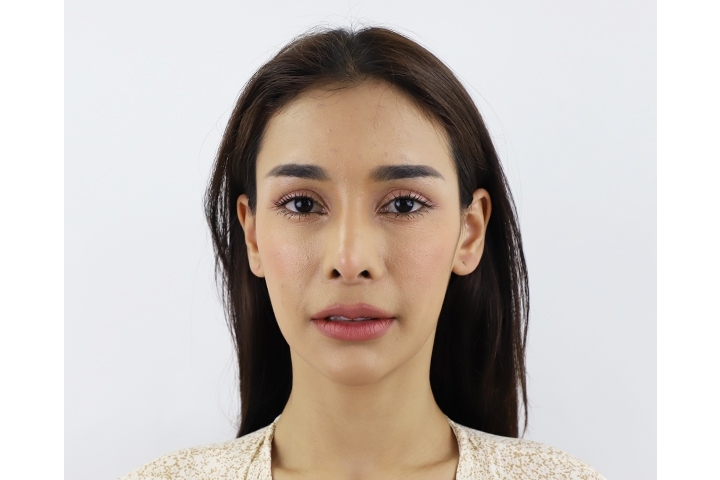 Reviews for Forehead Augmentation