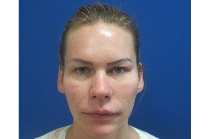 Reviews Hairline Lowering Surgery / Scalp Advancement / Forehead Reduction