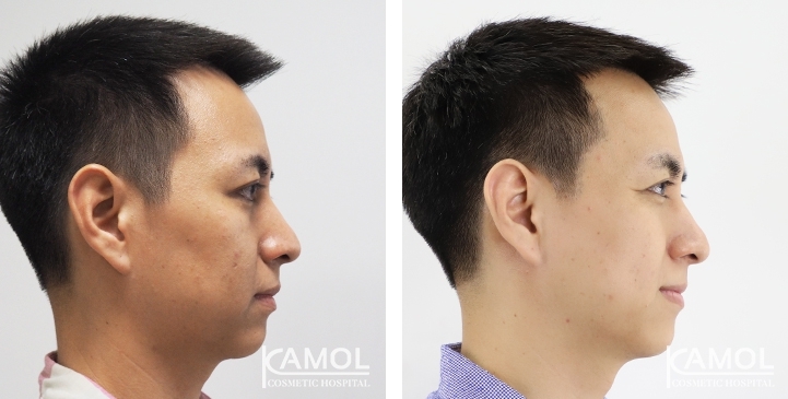 Before & After Forehead Lift / Browlift / Temporal Lift