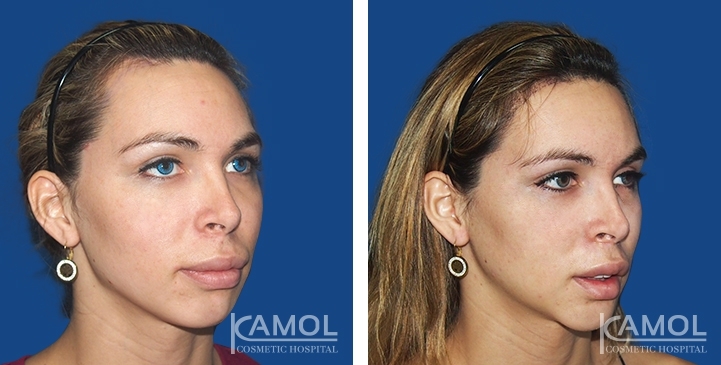 Before & After Chin Enhancement / Chin Implant Surgery / Chin Augmentation 