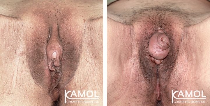 Before and After Metoidioplasty