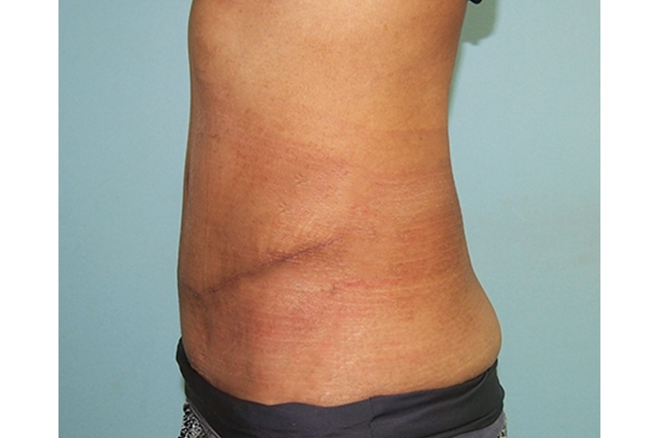 Reviews: Tummy Tucks