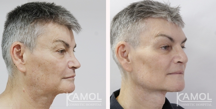 Antes y Después de la Masculinización Facial