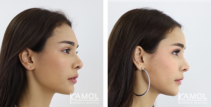 Before And After Forehead Implant