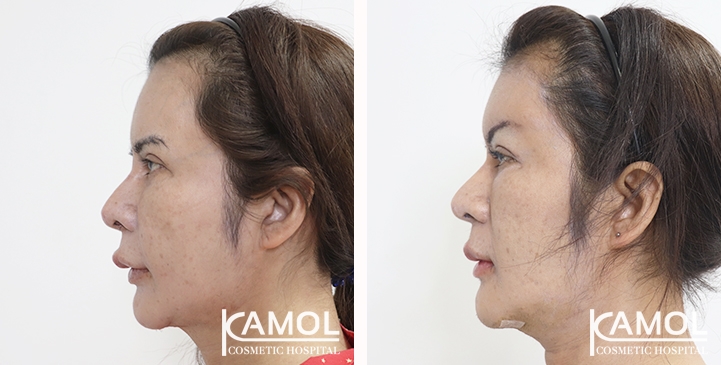 Before and After Forehead Implant