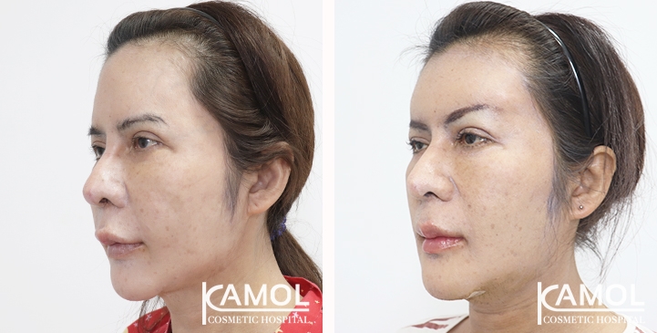 Before and After Forehead Implant