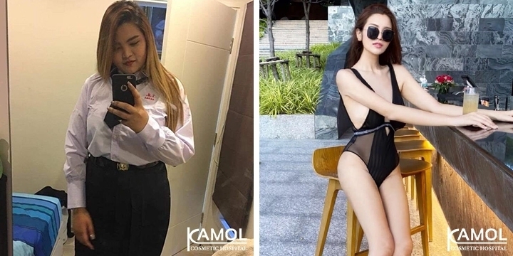 รูปก่อนและหลัง ผ่าตัดยกกระชับ แขน ขา หน้าท้อง หลังผ่าตัดกระเพาะ