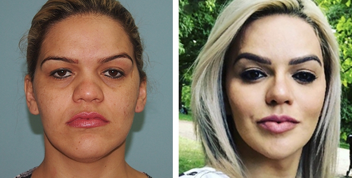 Rhinoplasty, boosts my confidence and makes me become another version of sociable Flavia.