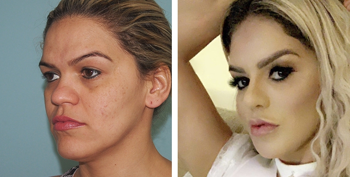 Rhinoplasty, boosts my confidence and makes me become another version of sociable Flavia.
