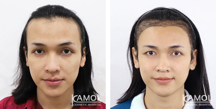 Feminine Hairline