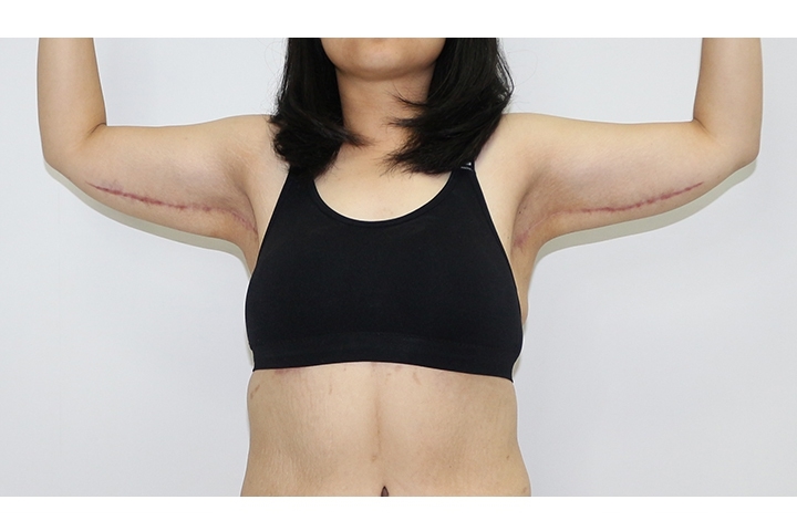 Arm Lift