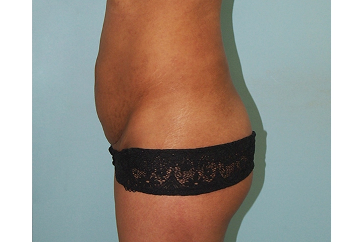 Lipectomie