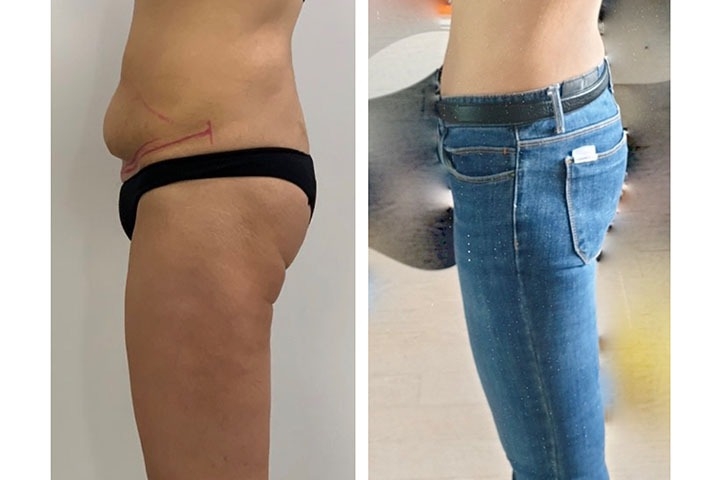 Avis sur le lifting des cuisses