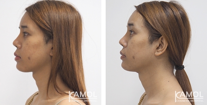 Before & After Adam's Apple Shaving