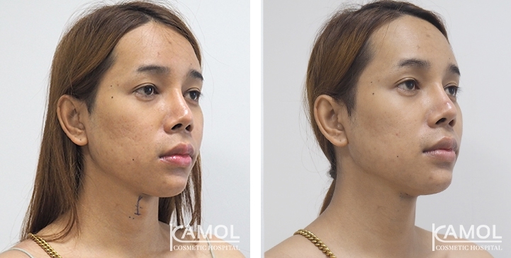 Before & After Adam's Apple Shaving