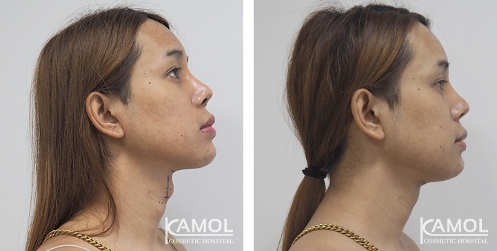 Before & After Adam's Apple Shaving