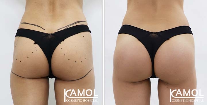 Buttock 01