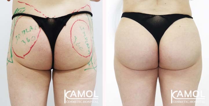 Buttock 001