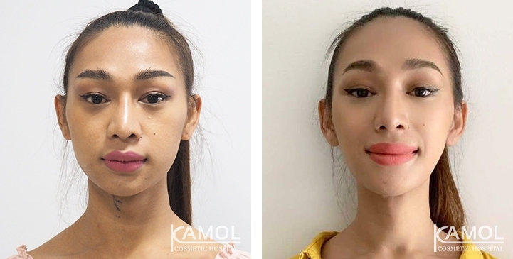Before & After Adam's Apple Shaving