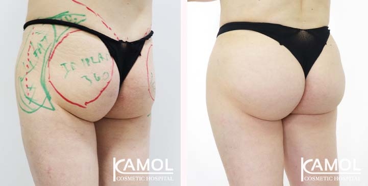Buttock 002