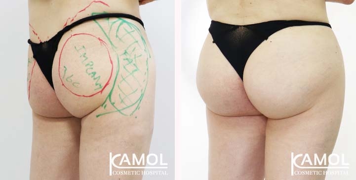 Buttock 004