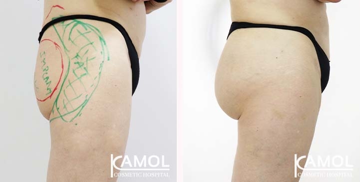 Buttock 005