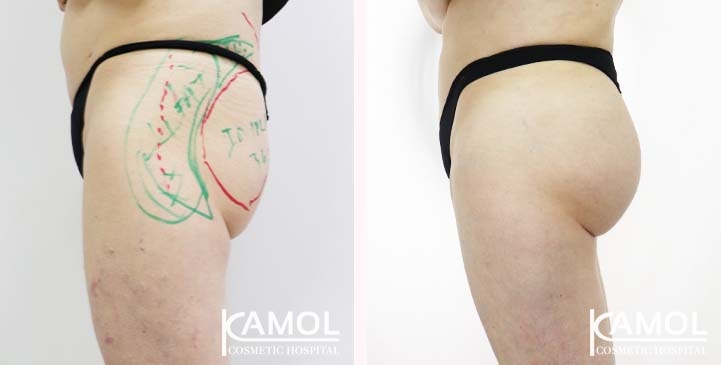 Buttock 003