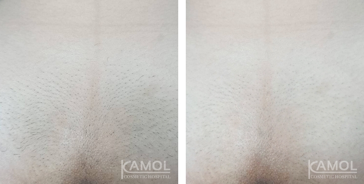 Before after กำจัดขน03
