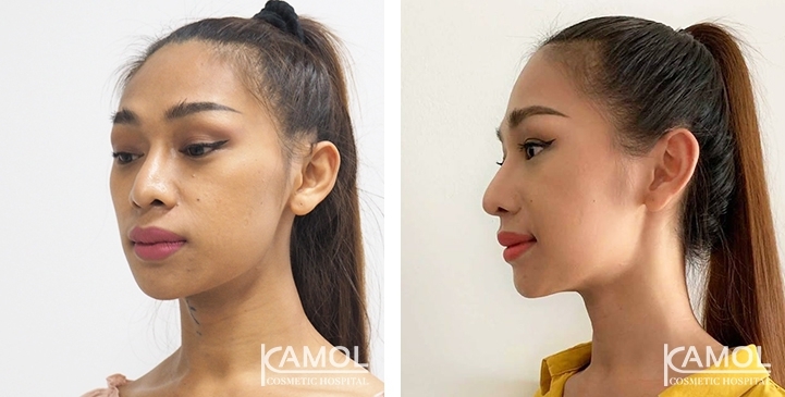 Before & After Adam's Apple Shaving