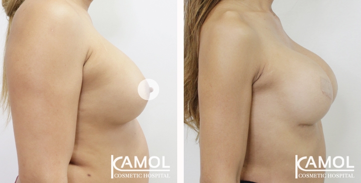Breast lift and breast reduction after surgery 1 year (2)