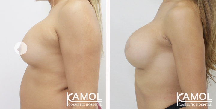 Breast lift and breast reduction after surgery 1 year (5)