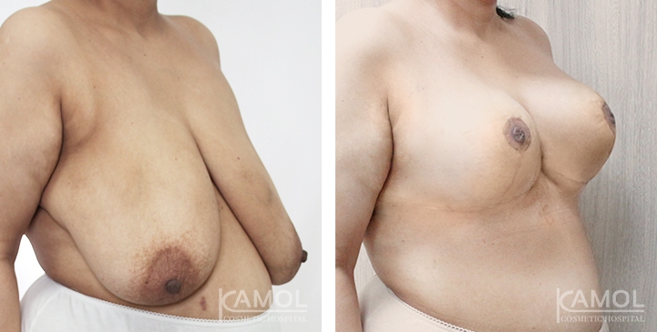 Before after 02-1 0