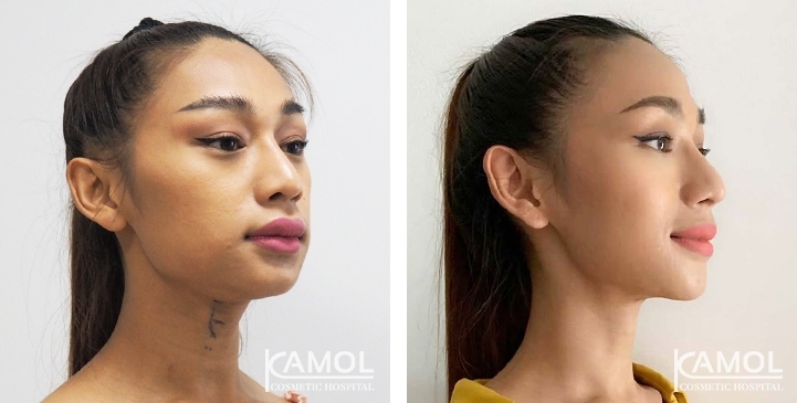 Before & After Adam's Apple Shaving