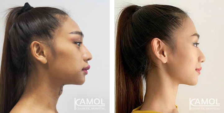 Before & After Adam's Apple Shaving