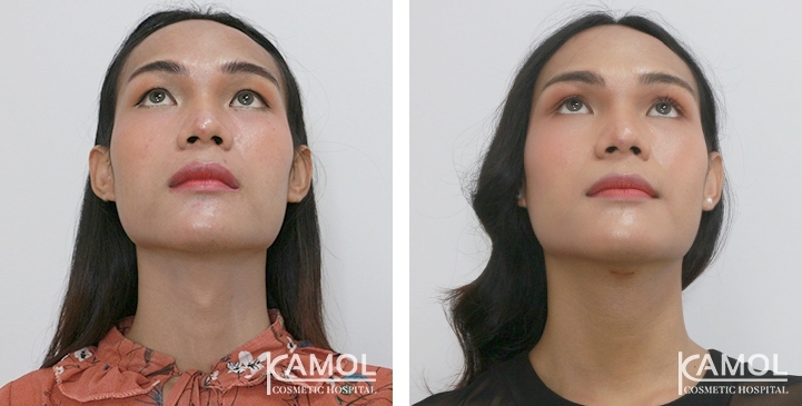 Before & After Adam's Apple Shaving