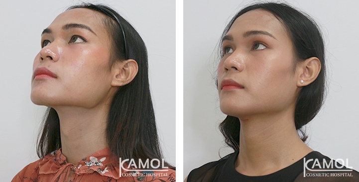 Before & After Adam's Apple Shaving