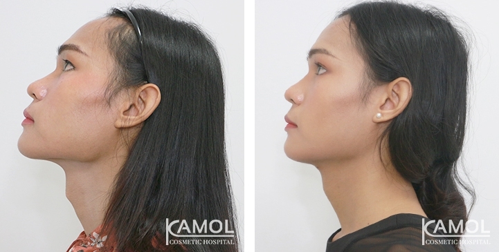 Before & After Adam's Apple Shaving