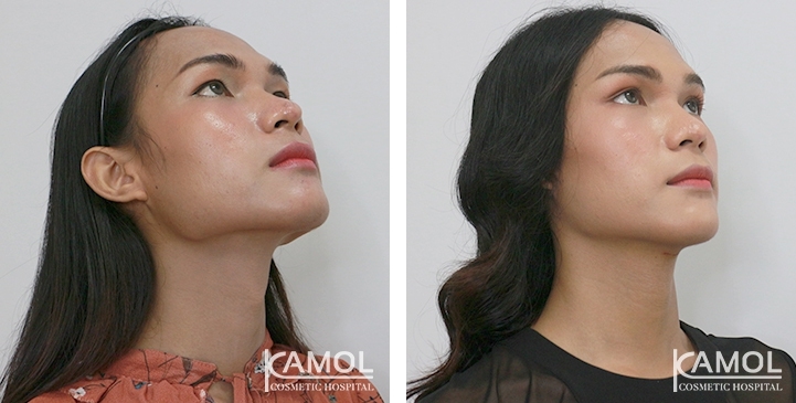 Before & After Adam's Apple Shaving