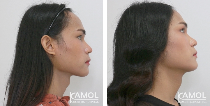 Before & After Adam's Apple Shaving